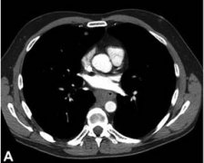 Barrett食管病怎么治療？