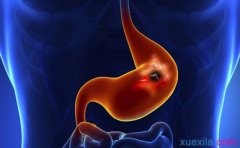 從這五方面著手，能夠有效預(yù)防胃息肉！