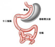 胃大部切除術(shù)后，病人飲食如何調(diào)配