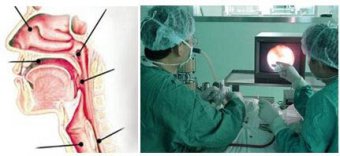 低溫等離子技術(shù)的臨床運用——耳鼻喉科