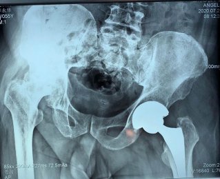 精于微創(chuàng)|山醫(yī)集團(tuán)濰坊市市立醫(yī)院骨二科成功開展微創(chuàng)髖關(guān)節(jié)置換術(shù)