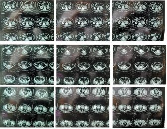 醫(yī)患同心抗病魔，多科合作顯神威 ——泌尿外科成功實(shí)施一例老年女性左側(cè)泌尿系及膀胱根治性切除手術(shù)